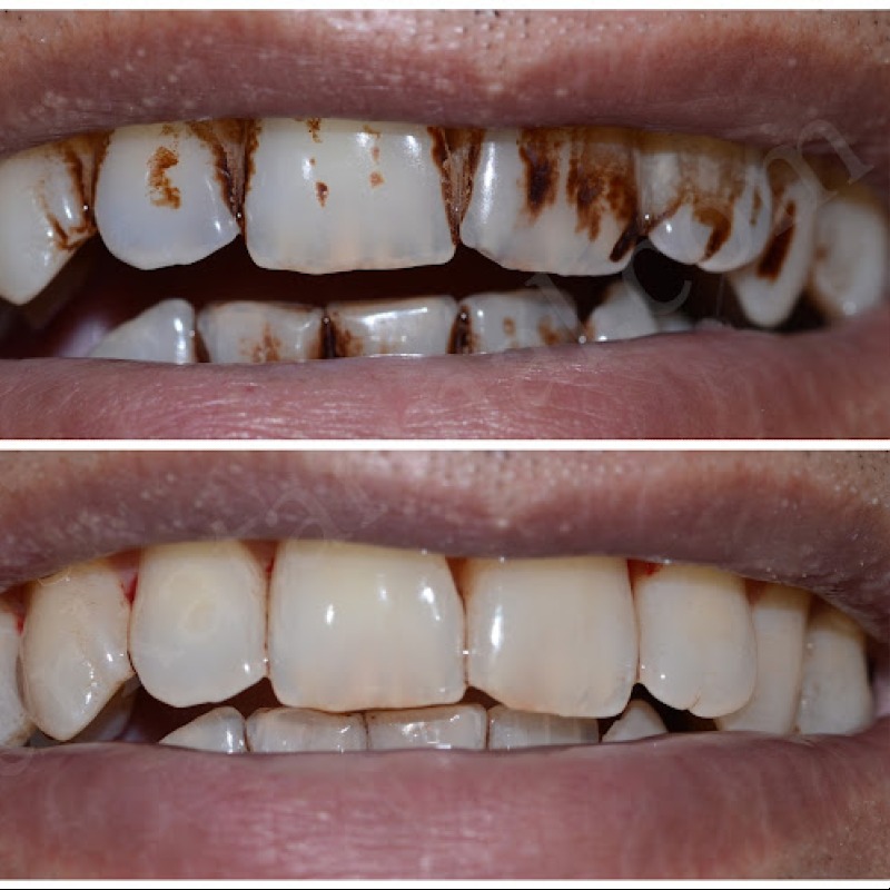 Instatnt pan stain removing Liquid